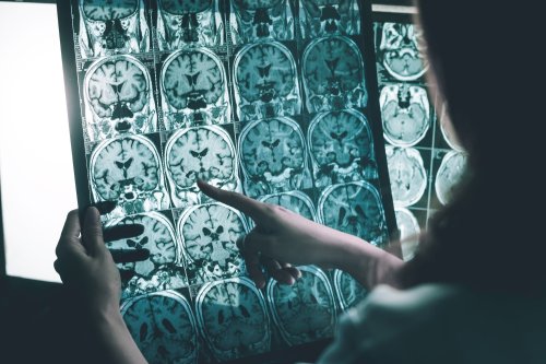 Advanced neuroimaging reveals surprising link between glaucoma and Alzheimer's disease