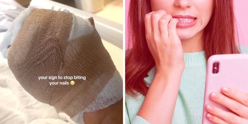 Here’s How Did Nail Biting Landed One Woman In The Hospital