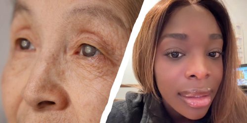 Eye Doctor Shares The Truth About Cataracts. Here’s How To Try To Avoid Them