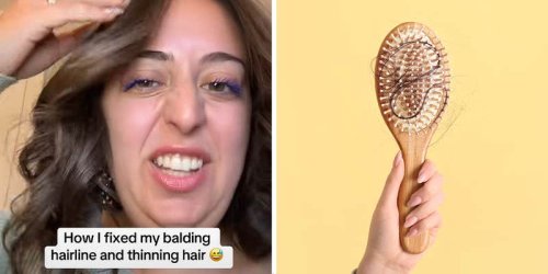 ‘Nothing was working’: Woman loses clumps of hair during weight-loss journey. Then she tries this serum