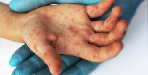 "Highly contagious": Measles cases in Canada over three times the number reported in 2023