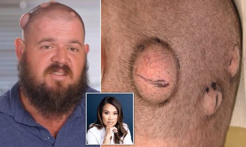 Iguana wrangler, 38, who had giant egg-like cysts on his head since he was 14 finally has them removed by Dr Pimple Popper - covering her assistant in goo