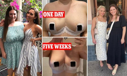 Nurse, 27, who was embarrassed by her 16H cup chest gets 'life-changing' reduction after years of pain and wearing baggy clothes to hide her size