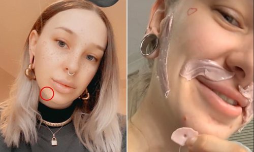 Woman accidentally waxes her mole off after DIY treatment goes wrong