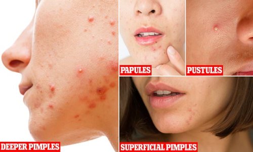 What type of spots do YOU have? Expert reveals the six different kinds of pimple and how to treat them (and squeezing IS allowed)