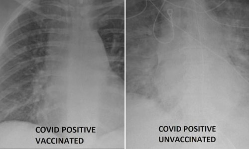X-rays show difference between unvaccinated and vaccinated patients