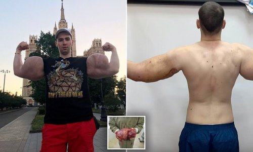 'Popeye' bodybuilder who created huge biceps by injecting himself with ...