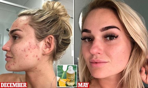 Aussie brand sells miracle oil that rapidly clears scars and acne