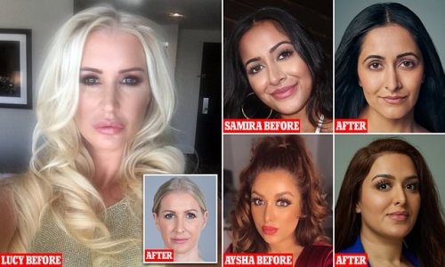 As more and more women have their ‘trout pout’ fillers dissolved, ALICE HART-DAVIS asks... Is this finally the kiss of death for Love Island lips?