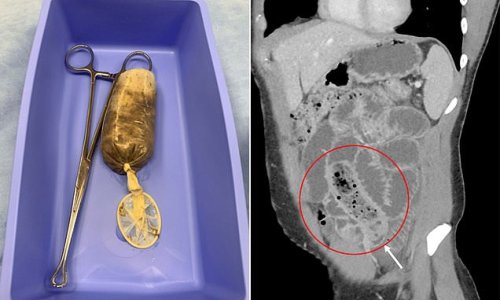 Man, 34, swallows whole banana wrapped in CONDOM during a 'fit of hormonal rage' as baffled Iowa doctors desperately dig it out of his small intestine