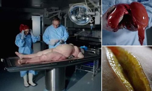 TV autopsy reveals what being fat REALLY does to your body