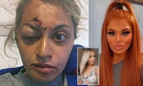 Pictured: Woman's smashed face after she was brutally attacked with a hammer by jealous 'love rival' at house party - as thug AVOIDS jail