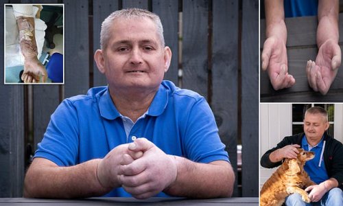 Scottish father-of-three, 48, with crippling skin condition becomes world's first sufferer to get double HAND transplant to cure it – and hails the 'amazing' result