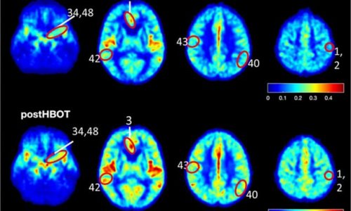 Australian study finds drugs could help treat Alzheimer's