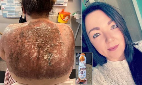 Mum has to go to hospital with sunburn despite wearing suncream