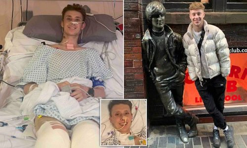 Man, 21, is forced to have both legs amputated just days before his birthday after he was struck down with flu and pneumonia which developed into sepsis