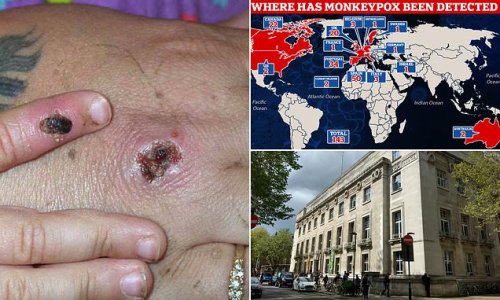 British CHILD is in intensive care with monkeypox: Shock news emerges as scientists say they warned THREE YEARS ago the disease risked filling the void left by smallpox if action wasn't taken