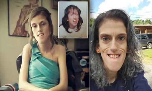 Mother, 27, born with a rare muscle condition that left her with facial deformities hits back at 'evil trolls' who call her a 'MONSTER' - insisting she 'loves showing others it's okay to be different'
