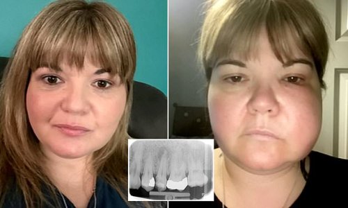 Woman, 44, who was left having to drain her OWN swollen gum of pus and with 'multiple rotting teeth' after inadequate dental care wins £15,500 in legal settlement