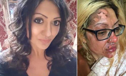 Mother left in 'absolute agony' after a microwaved poached egg EXPLODED in her face while trying a viral TikTok hack