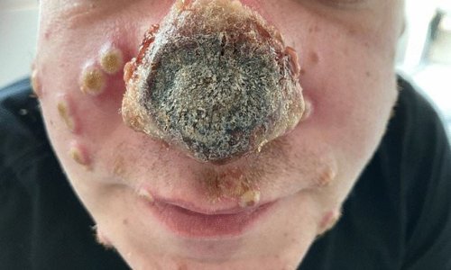 Pictured: German monkeypox patient whose nose started to ROT because his undiagnosed HIV and syphilis left his immune system ravaged