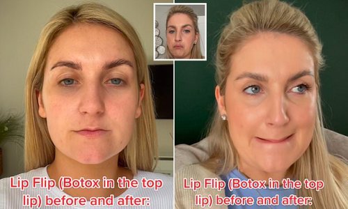 Woman opens up about her Botox 'lip flip' procedure, which she describes as the 'most annoying thing ever', saying it left her struggling to rub her lips together, speak, and drink