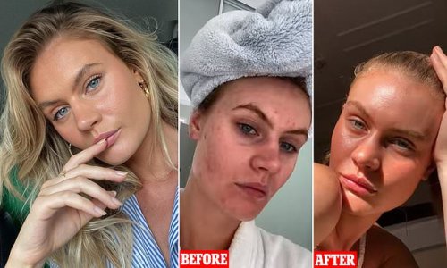 Model who struggled with severe acne reveals the 'secret' weapon she used to achieve 'glassy smooth skin' in just six months: 'You can thank me later'