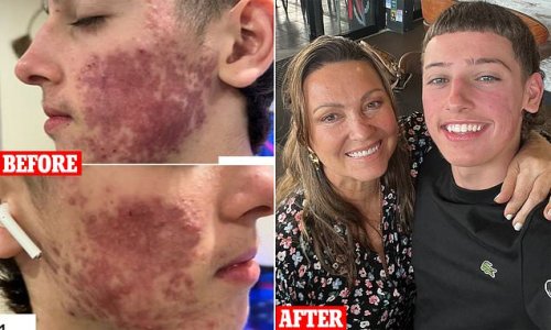 How schoolboy, 15, got rid of his severe acne in just 11 weeks - thanks to a natural skincare regime