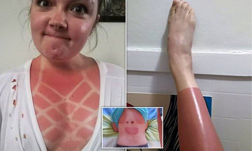 Ouch! People show off their eye-watering sunburn in embarrassing snaps that will have you reaching for the factor 50