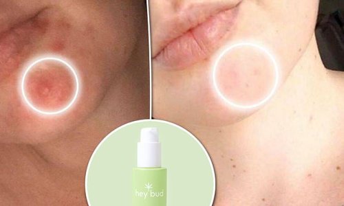 Combats acne and ageing! This new Niacinamide + Hemp serum is causing shoppers to show off incredible Before and After pics with visibly clearer skin - and DailyMail readers can save 15%
