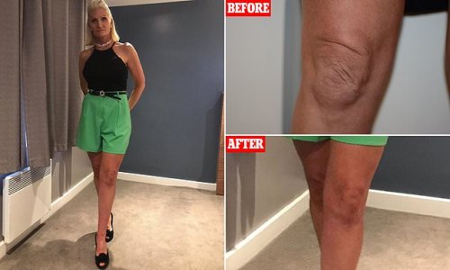 Cyclist, 50, who was self-conscious of her 'saggy' knees says she finally has the confidence to wear shorts after undergoing non-surgical procedure to lift and tighten her skin