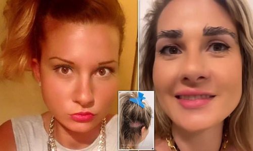 Woman, 36, who spent 30 minutes drawing on her eyebrows daily after over-plucking as a teenager has a transplant using hair from her HEAD - but has to trim them monthly because they won't stop growing