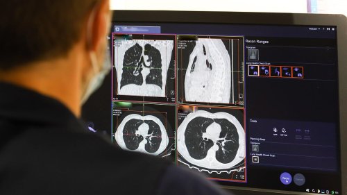 Scientists are making a 'groundbreaking' lung cancer vaccine that could prevent up to 90% of cases