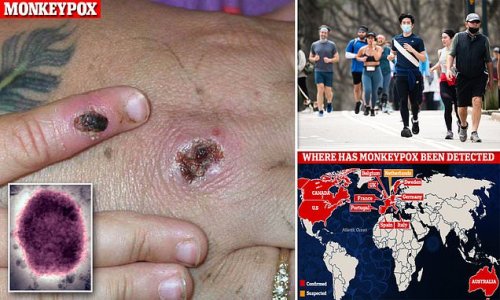 Another virus, another mask! NYC tells locals to don a face covering after New Yorker tests positive for virus related to monkeypox: CDC issues alert and WHO calls emergency meeting after US probes six cases while Europe confirms 100