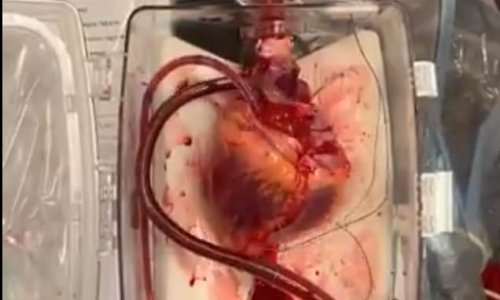 Doctors bring a dead heart 'back to life' for groundbreaking transplant