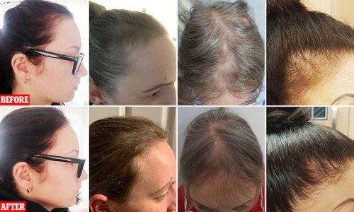 Balding women who felt self-conscious after losing hair due to stress,  menopause and over-styling claim £35 protein capsules have left their locks  looking 'thicker than ever' | Flipboard