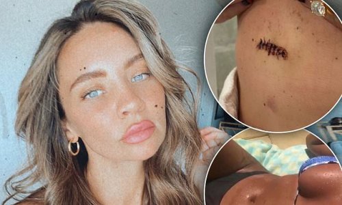 Braith Anasta's fiancée Rachael Lee reveals her scars after having skin cancer removed - as she says getting checked 'saved my life'