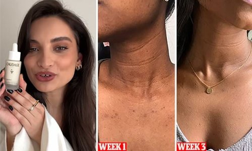 How to banish dark spots and acne scars in THREE weeks: The pictures that show why this 'miracle' French serum is selling every 30 seconds