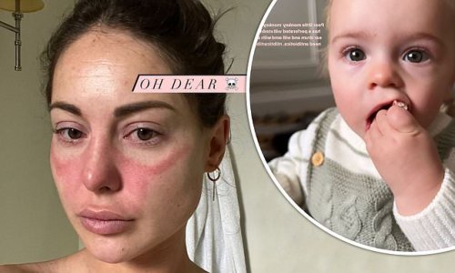 'I feel like my immune system is attacking my face': Louise Thompson shares picture of 'horrendous' rash and reveals her son Leo is suffering from a perforated ear drum