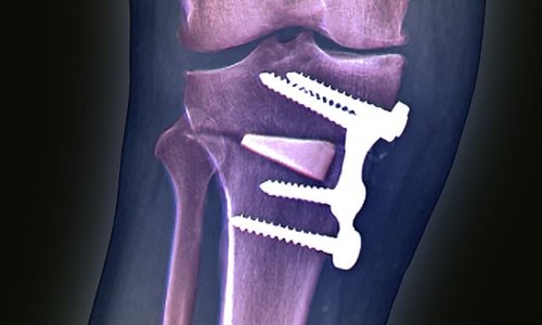 Arthritis experts call for up to 10,000 NHS patients to be offered knee operation that avoids trauma of costly and invasive joint-replacement