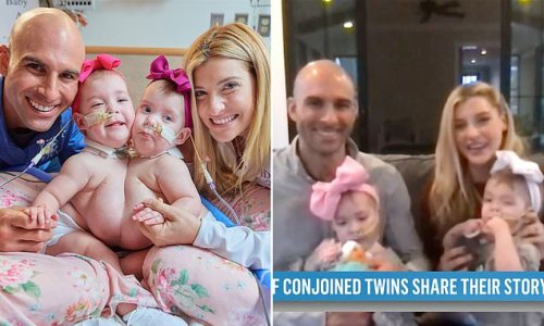 11-month-old conjoined twins are separated after 10-hour surgery
