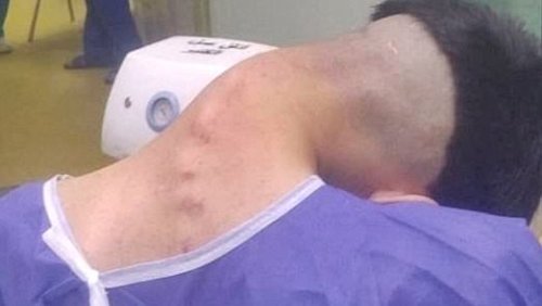 Man, 23, develops shocking 'dropped head syndrome' after battling addiction to one habit for years