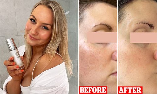 Young woman shares the FOUR skincare products she used to get rid of her melasma in two months