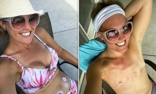 Breast cancer survivor, 40, who got implants after double mastectomy details excruciating three-year battle with breast implant illness that was ignored by TEN doctors - and left her with hair loss, brain fog, joint pain, and PURPLE TOES