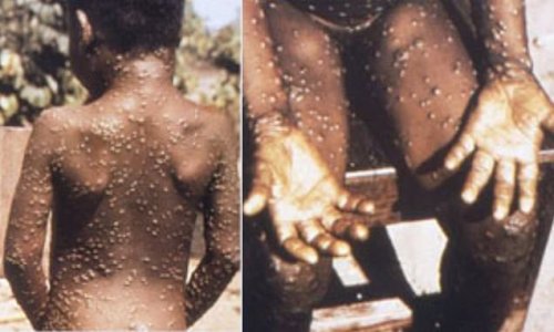 EVERYTHING you need to know about monkeypox: Strain spreading in UK 'transmits through sex' and is about as deadly as the Wuhan Covid variant — but UK doesn't have a vaccine