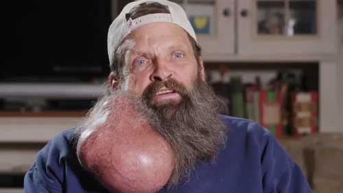 Arizona man has watermelon-sized neck tumor that started as a pimple