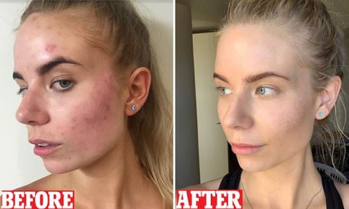 After battling painful cystic acne since high school business owne has healed her skin for good