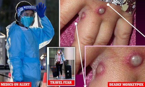 Monkeypox comes to Australia: Traveller with symptoms of the killer virus is rushed into isolation as Kerry Chant issues an urgent warning to Aussies
