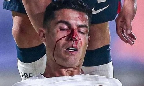 Cristiano Ronaldo suffers HORROR injury in Portugal's thrashing of Czech Republic with the Man United star's face covered in blood after a clash with keeper Tomas Vaclik... but the forward still managed the full 90 minutes