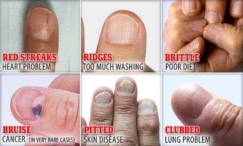 What Do YOUR Fingernails Say About Your Health Brittle Nails May Be A 